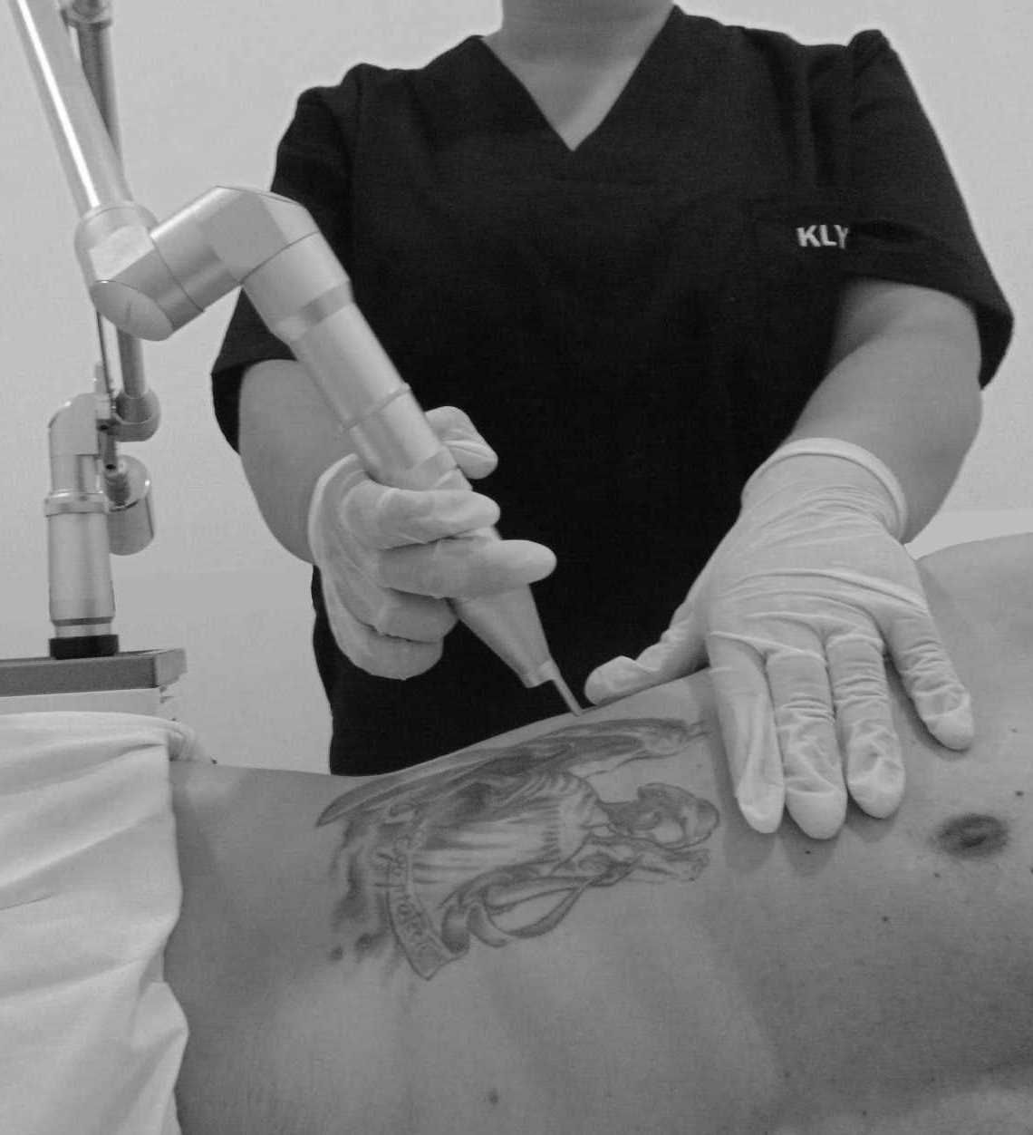 borrado de tatuajes klynink tecnologia eliminacion laser tatuajes klynink